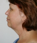 Feel Beautiful - Necklift San Diego Case 15 - Before Photo